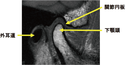 顎関節のレントゲン画像